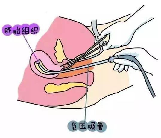 最新妇科流产技术及风险：解读2023年妇科流产现状与未来趋势