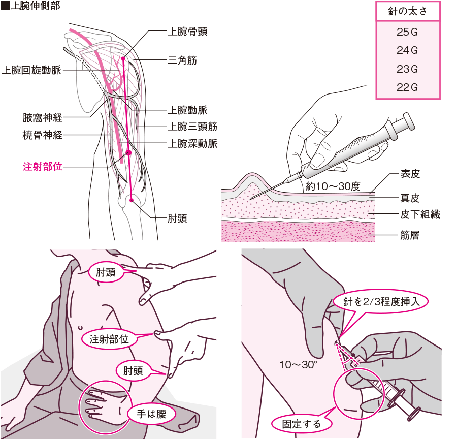 过敏性鼻炎最新治疗方法全解析：从药物到生物制剂，探寻最佳方案