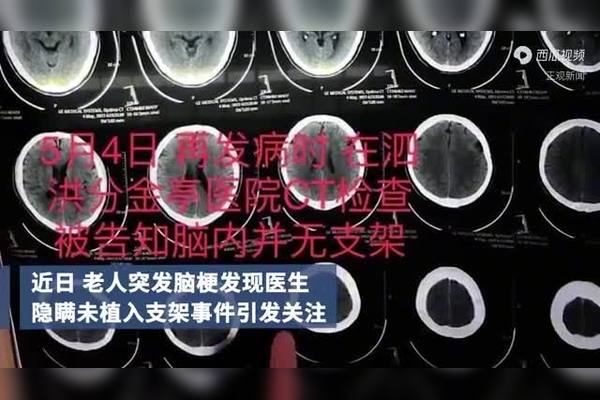 最新治脑梗手段及疗效分析：神经保护、溶栓与微创介入技术